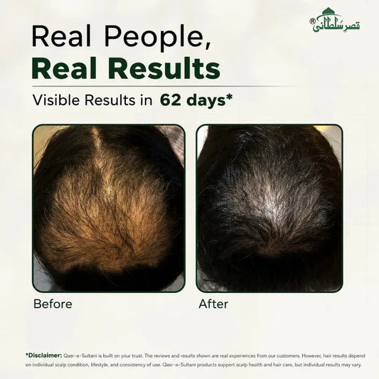 Promotional graphic for Qasar-e-Sultani hair care showing a before-and-after comparison of hair density on top of heads. The text reads 'Real People, Real Results' and 'Visible Results in 62 days*'.